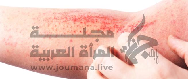 إلتهاب الجلد التحسسي