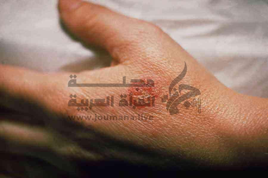 التهاب الجلد التحسسي