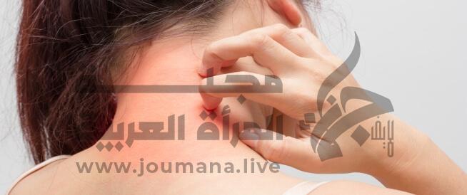 حساسية الجلد أسبابها وأعراضها وطرق علاجها