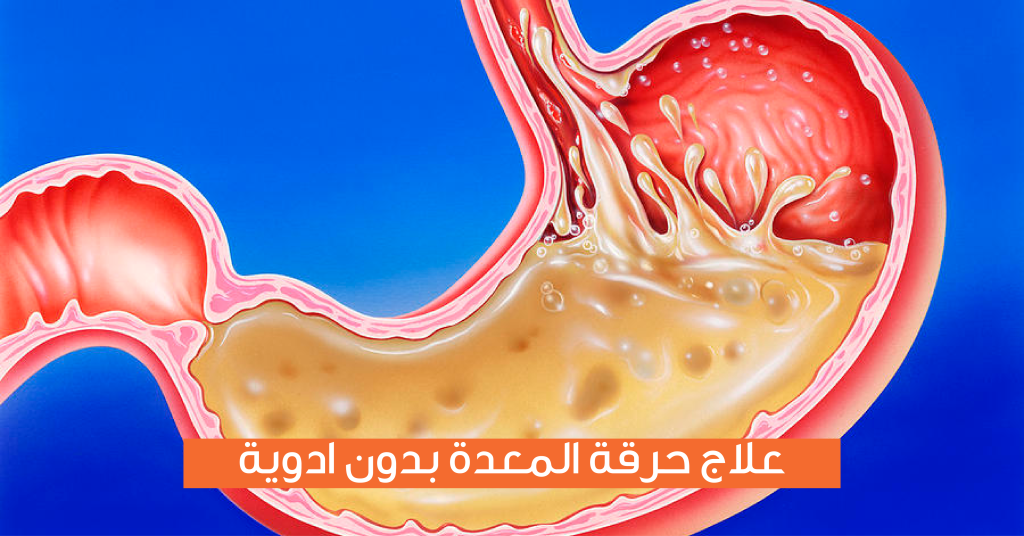 علاج حموضة وحرقة المعدة